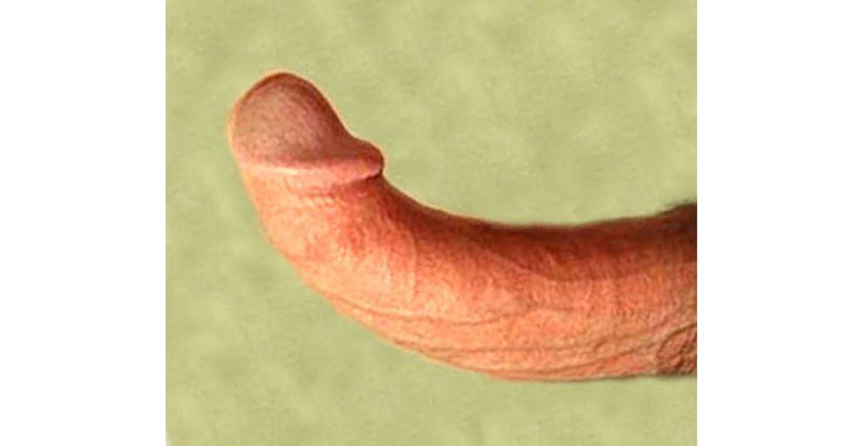 A curved penis differs from a bent one in that there is usually no scar tissue causing the penile curvature.