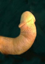 BentPenis5_PDtreatment_c_WEB