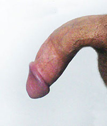 can a bent penis cause erectile dysfunction?