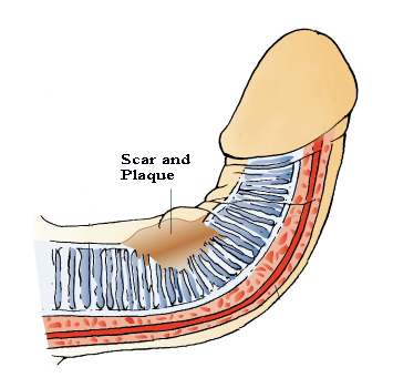 peyronies disease is caused by internal scar tissue and/or plaque deposits