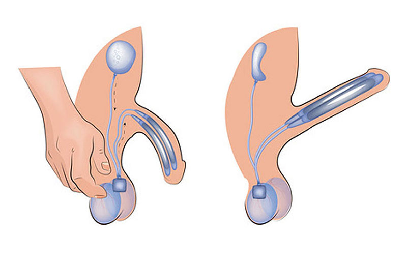 penile implant, erectile dysfunction, bent penis